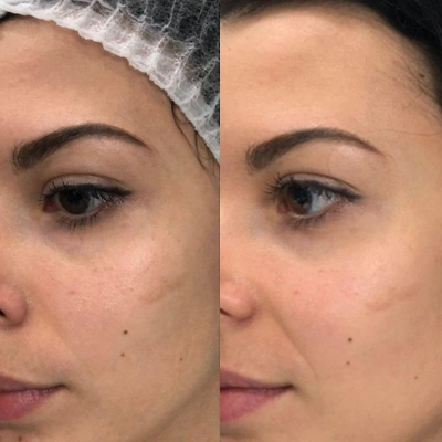 Microneedling Vorher Nachher bei Augen Festigen und Heben