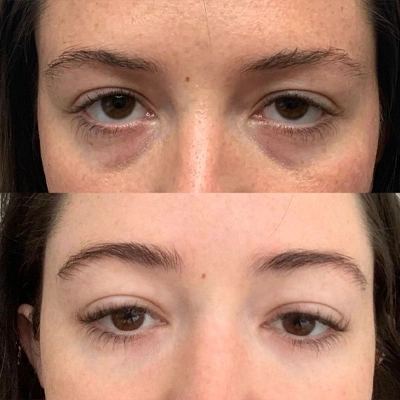 Microneedling Vorher Nachher bei Augen Straffung der Augenpartie