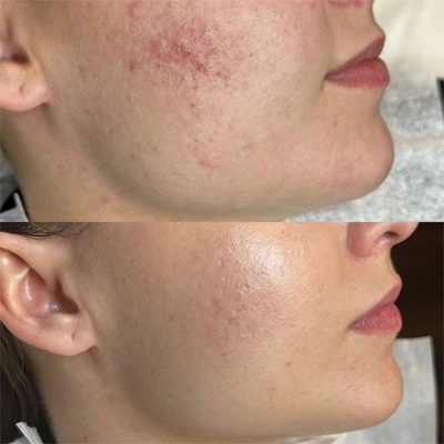 Microneedling Vorher Nachher bei Gesicht Akne Aufhellen