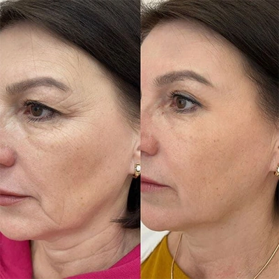 Microneedling Vorher Nachher bei Gesicht Pigmentierung Vermindern