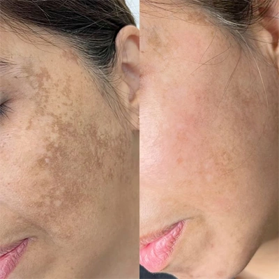 Microneedling Vorher Nachher bei Gesicht Dies ist die Überschrift