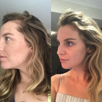 Microneedling Vorher Nachher bei Stärkt das Haar