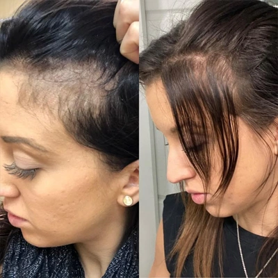 Microneedling Vorher Nachher bei Haarwachstum und Anti-Shedding