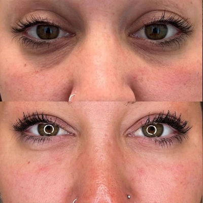 Microneedling Vorher Nachher bei Augen Augenfältchen Verblassen