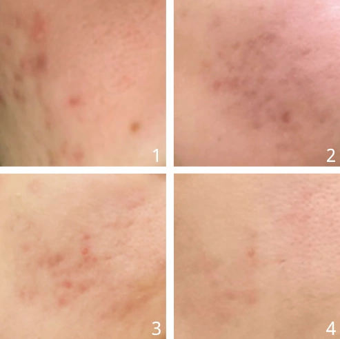 Vor und nach Microneedling bei Akne im Gesicht - Dr. Pen Germany