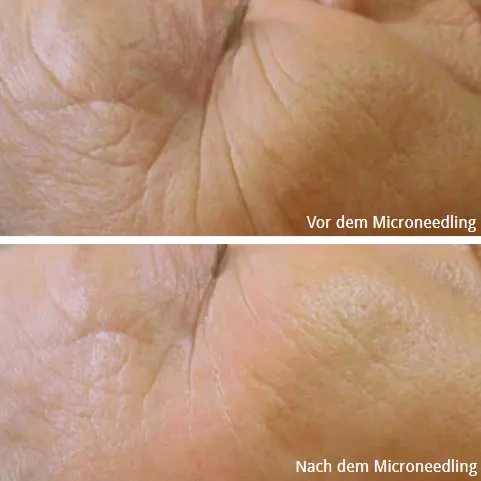 Dr. Pen Microneedling Ergebnisse vor und nach der Faltenbehandlung