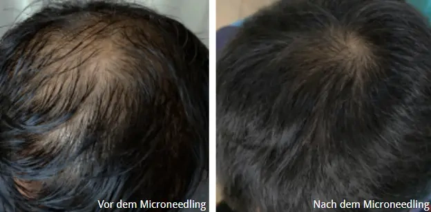Vor und nach dem Microneedling bei Haarausfall