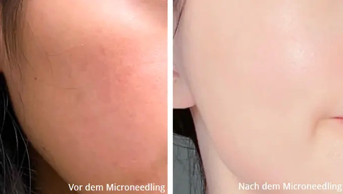 Ergebnisse vor und nach 2 Monaten Mikronadelbehandlung der Haut