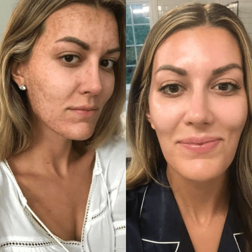 Dermapen Efekty Vorher Nachher