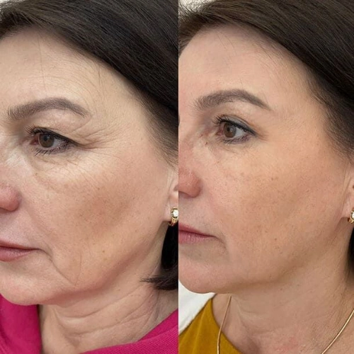 Dermapen Erfahrungen
