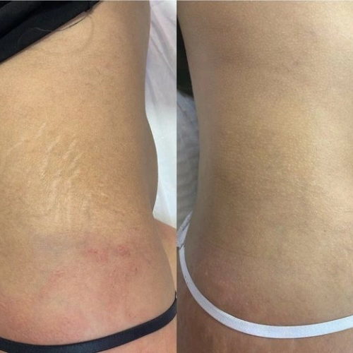 Dermapen Vorher Nachher Erfahrungen