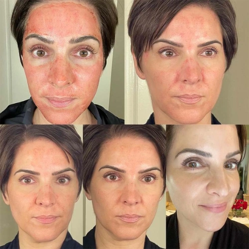 Dermapen Efekty 🌟 Vorher Nachher Erfahrungen