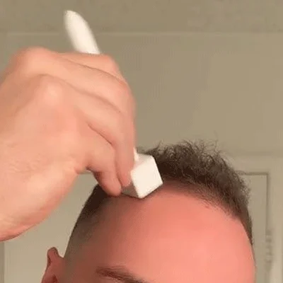 dr. pen microneedling germany hair grown